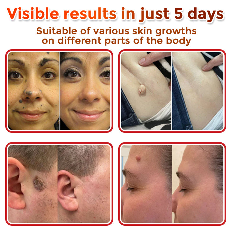 🎁 2-in-1 Bye-Bye Pimples Patch|Raised Moles,Acne Flat Warts & Skin Tags Remover