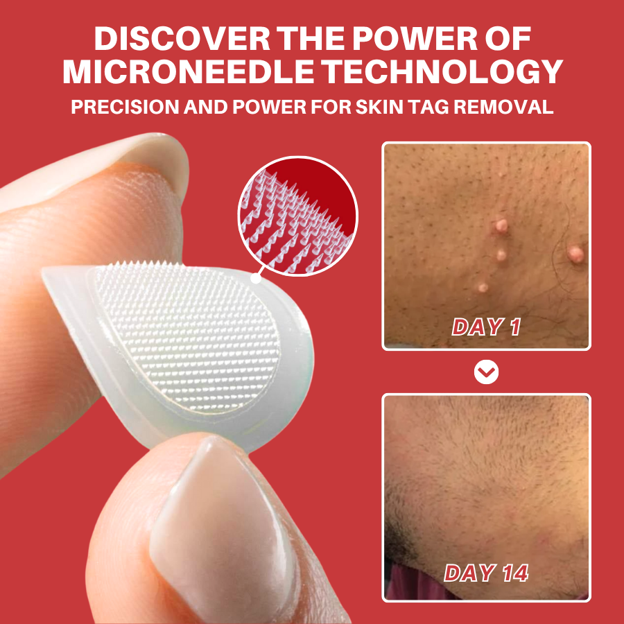 🎁 2-in-1 Bye-Bye Pimples Patch|Raised Moles,Acne Flat Warts & Skin Tags Remover