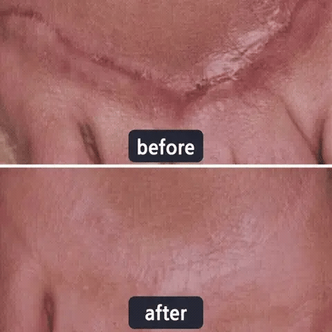 🔥Limited-time 50% sale--LUMIVO Scar Repair Cream — Smooth, Clear, Confident Skin