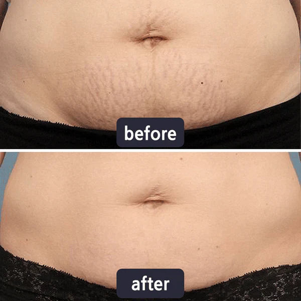 🔥Limited-time 50% sale--LUMIVO Scar Repair Cream — Smooth, Clear, Confident Skin