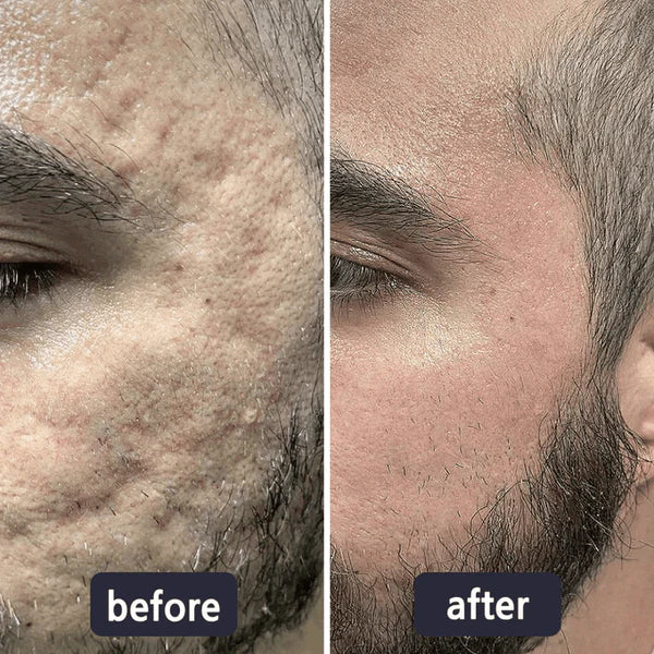 🔥Limited-time 50% sale--LUMIVO Scar Repair Cream — Smooth, Clear, Confident Skin