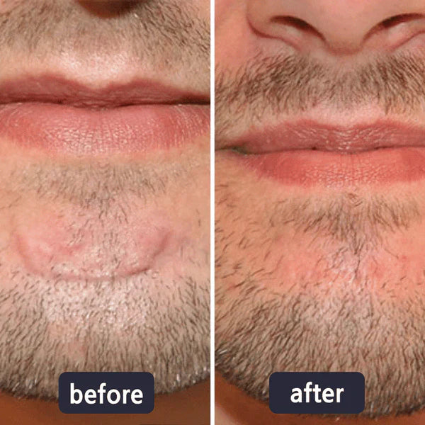 🔥Limited-time 50% sale--LUMIVO Scar Repair Cream — Smooth, Clear, Confident Skin