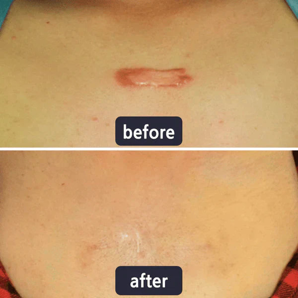 🔥Limited-time 50% sale--LUMIVO Scar Repair Cream — Smooth, Clear, Confident Skin